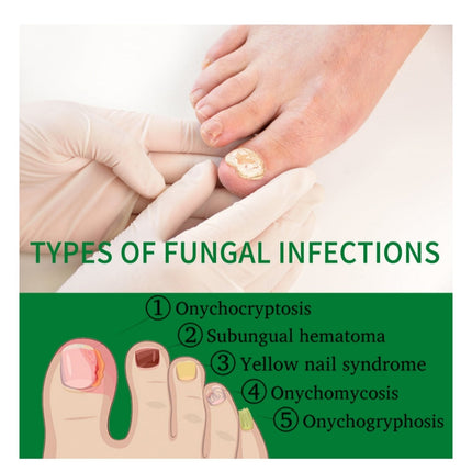 Nail Fungus Treatment Hand Foot Care Repair Gel