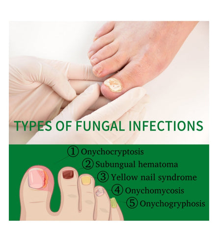 Nail Fungus Treatment Hand Foot Care Repair Gel